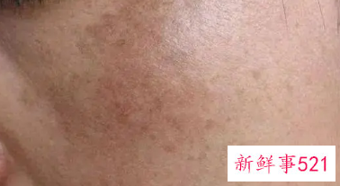 身体色斑增多是啥毛病