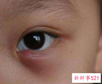 为什么会经常长麦粒肿呢