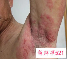 男性刚得了梅毒的照片