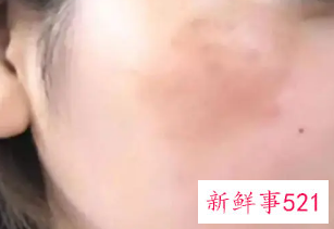 身体色斑增多是啥毛病