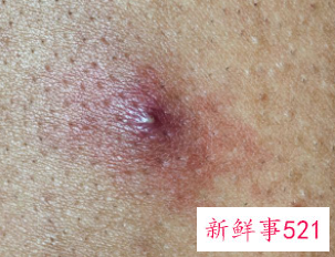 如何辨别皮肤是不是癣