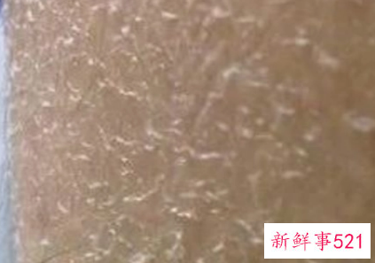 脸上起白色的皮屑图片