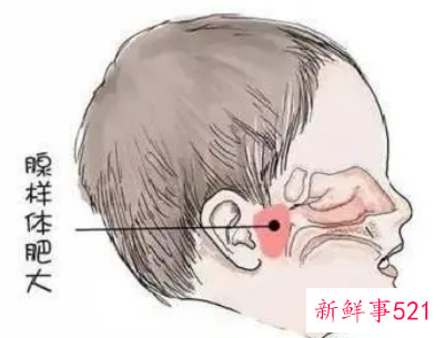 9岁小孩腺样体肥大怎么办