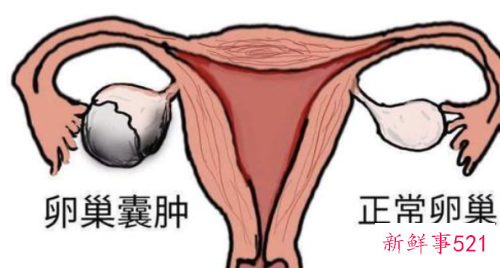 卵巢囊肿对怀孕的危害有哪些