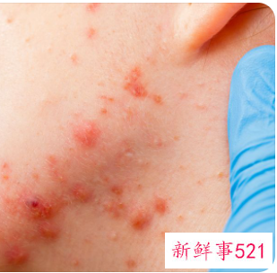 花粉过敏吃什么好喝什么好