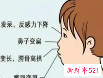 成人张嘴睡觉会影响面容吗