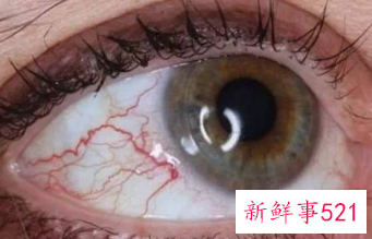 眼睛红血丝对应疾病