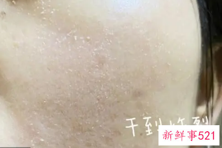 脸上起白色的皮屑图片