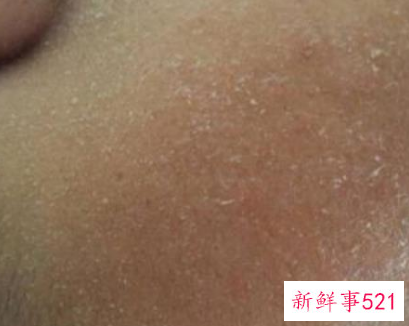 脸上起白色的皮屑图片