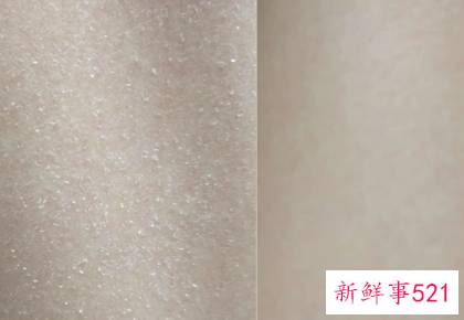 脸上起白色的皮屑图片