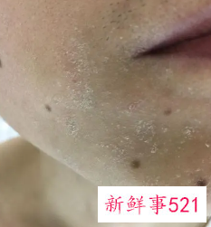 脸上起白色的皮屑图片