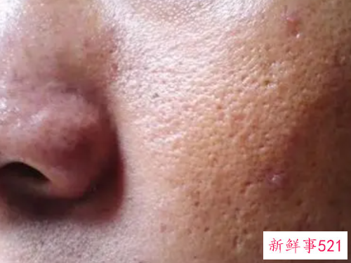 油性皮肤怎么根治痘痘用什么药