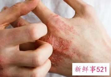 皮肤干燥脱屑像雪花一样是身体缺什么吗