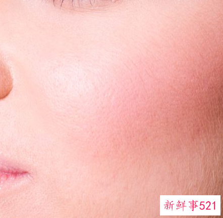 脸颊痘痘怎么去除