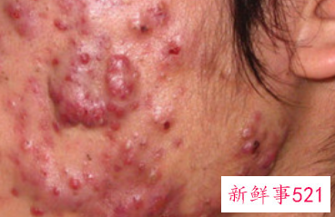 脸上总是长痤疮怎么排毒