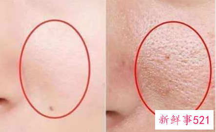 真正能缩小毛孔的方法