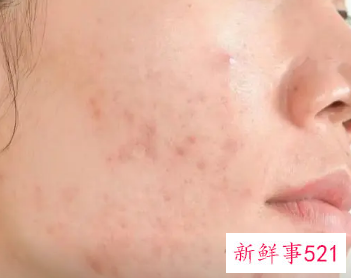 青春期女生痘痘怎么调理