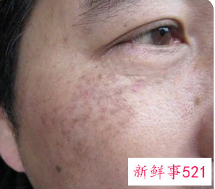 斑的分类及特点