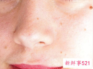 青春期女生痘痘怎么调理