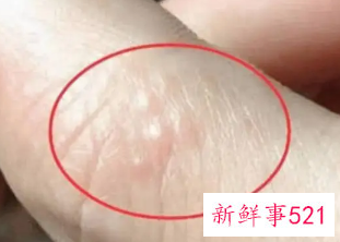 湿气重手指水泡怎么办