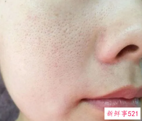 女士脸上毛孔粗大怎么办