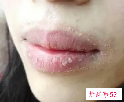 嘴角脱屑怎么办