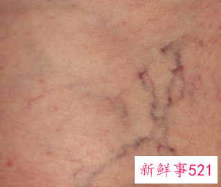 皮肤各种斑的图片介绍