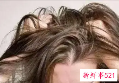 怎么根治油性头发