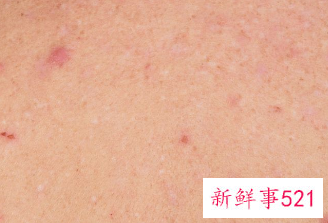 身上小红点是怎么回事
