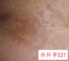 皮肤各种斑的图片介绍