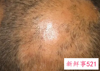 斑秃怎么治疗