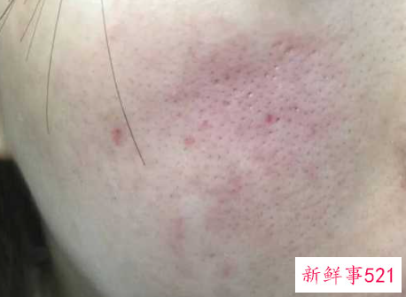 用洗面奶洗完脸后发红发烫