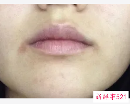 嘴角脱屑怎么办