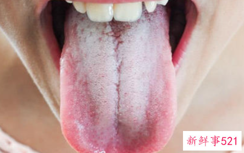 宝宝白色舌苔怎么办