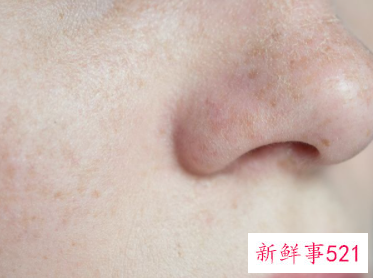 去除晒斑的小偏方