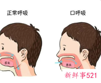 长期用口呼吸后果