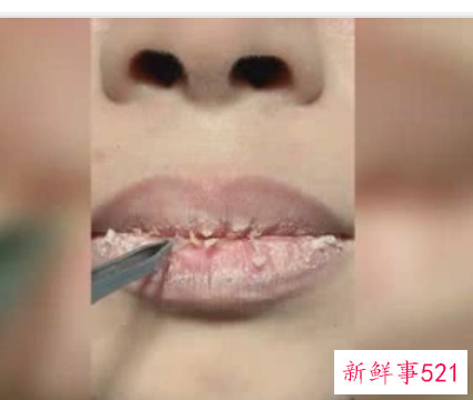 嘴角脱屑怎么办