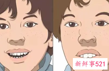 长期用口呼吸后果