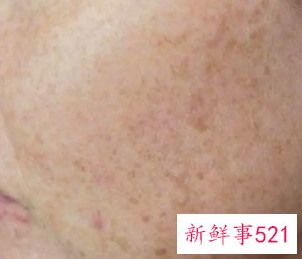 皮肤各种斑的图片介绍