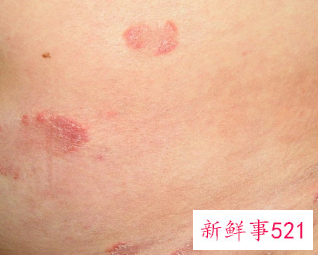 身上小红点是怎么回事