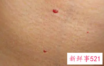 身上小红点是怎么回事