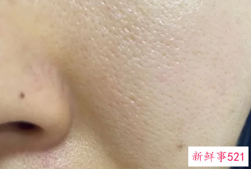女士脸上毛孔粗大怎么办