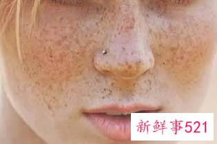 皮肤各种斑的图片介绍
