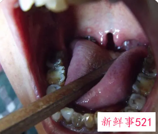 小舌头下垂是什么原因引起的