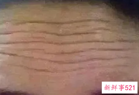 额头突然出现很深的皱纹