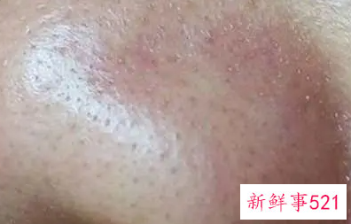 五大因素引起毛孔粗大