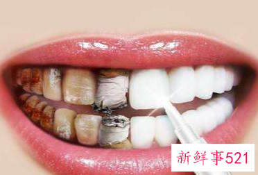 牙齿黄有什么快速解决的方法