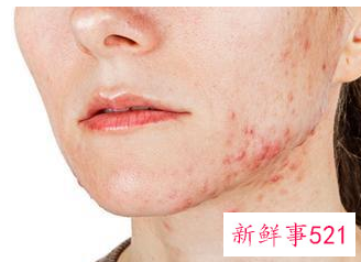 怎么消除脸上的粉刺