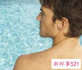 黑色痘印怎么快速消除