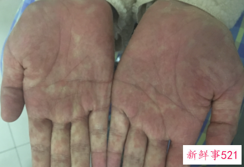 皮肤干燥症的症状